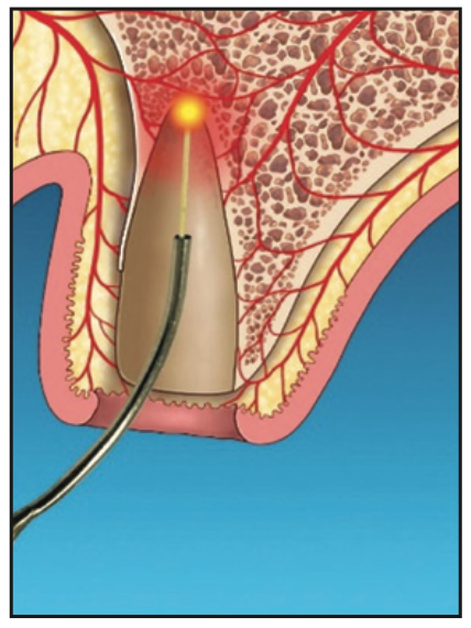 laser-assisted socket grafting