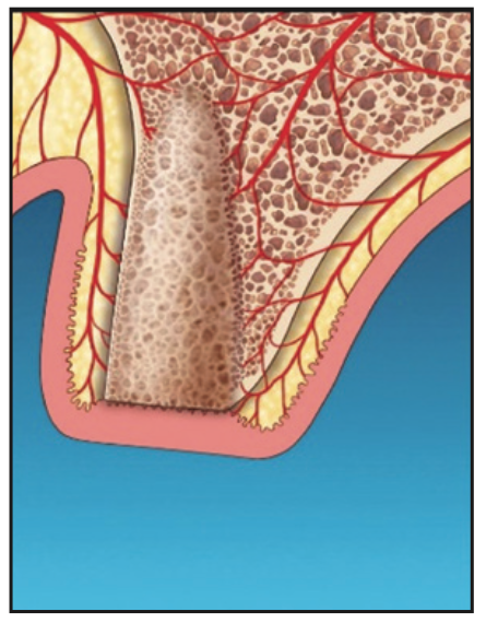 laser-assisted socket grafting