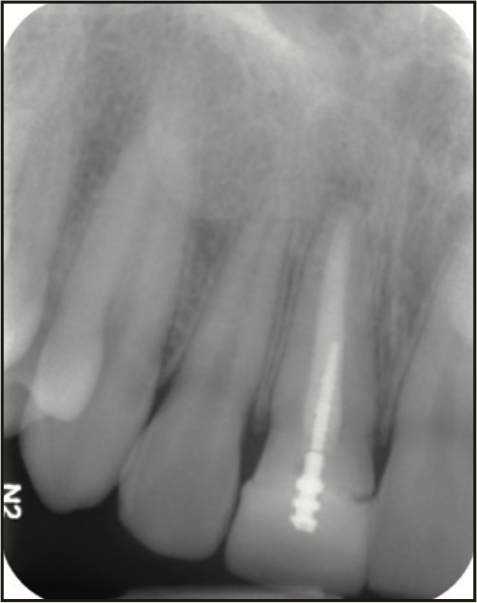 laser-assisted socket grafting
