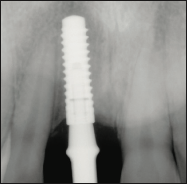 laser-assisted socket grafting