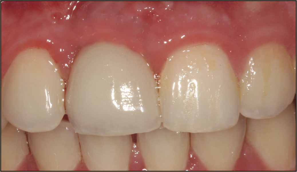 laser-assisted socket grafting