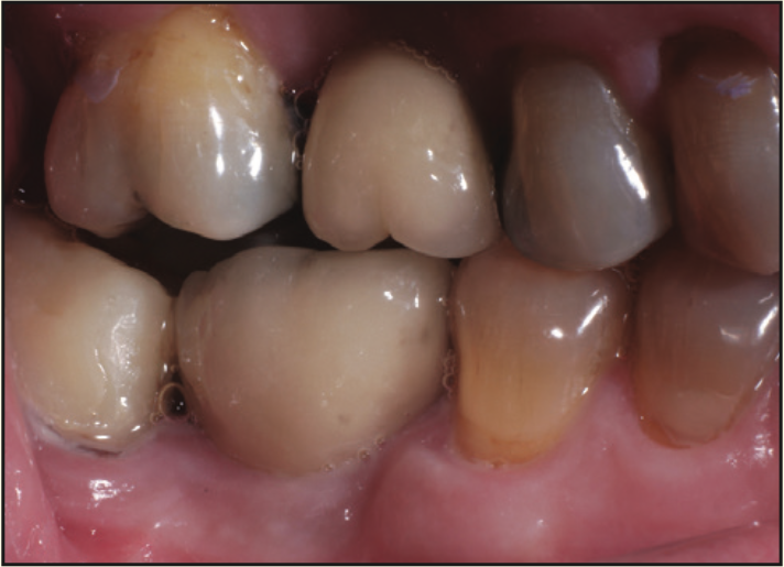 laser-assisted socket grafting