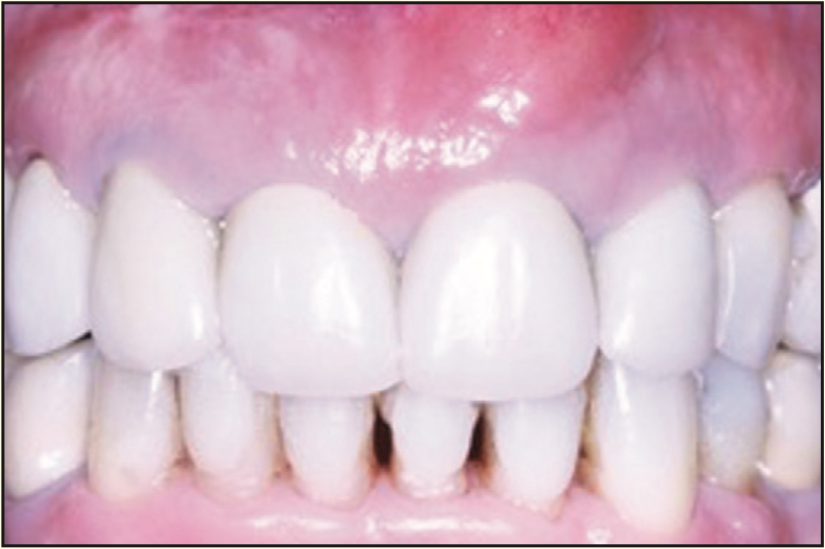 laser-assisted socket grafting