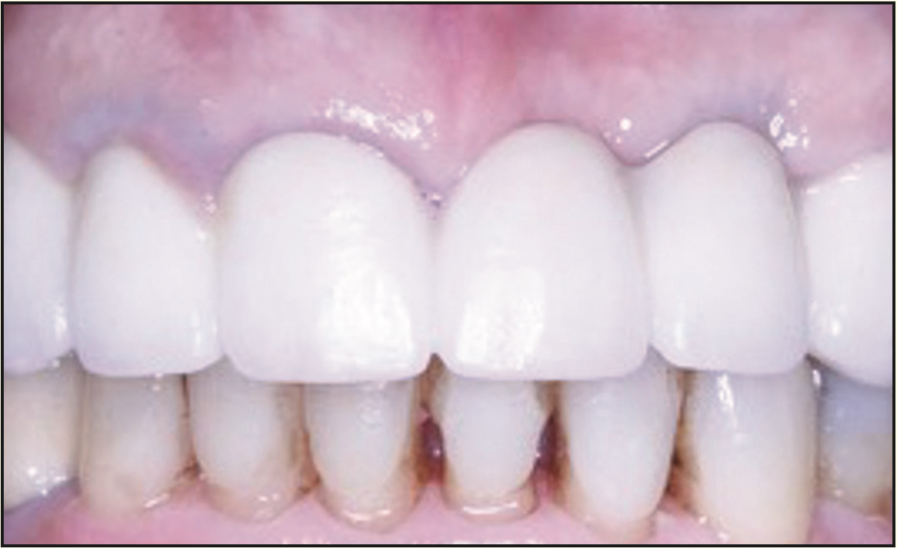 laser-assisted socket grafting