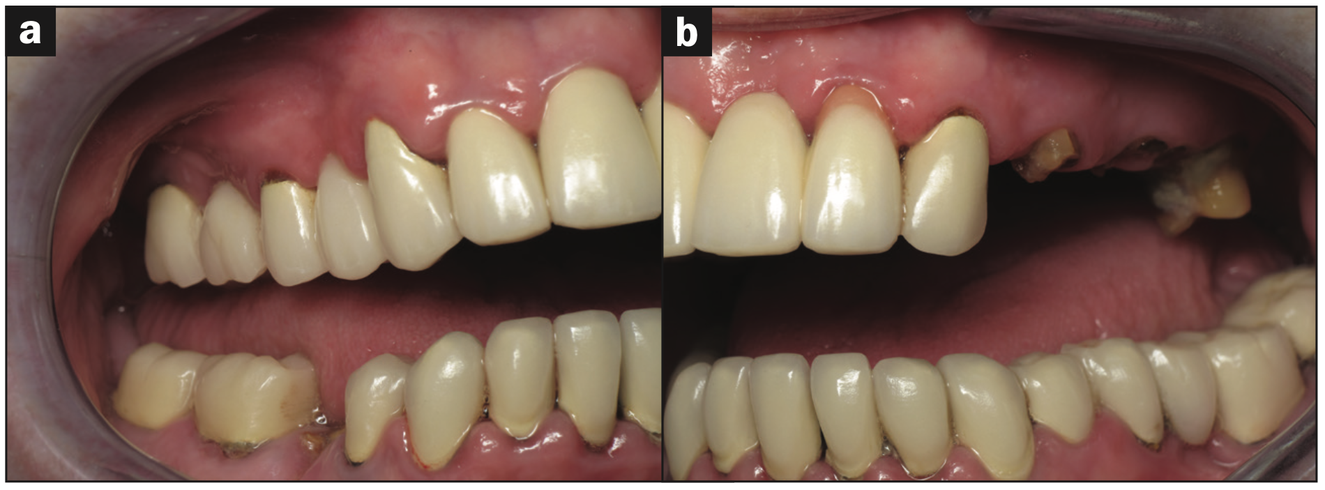 full-mouth rehabilitation