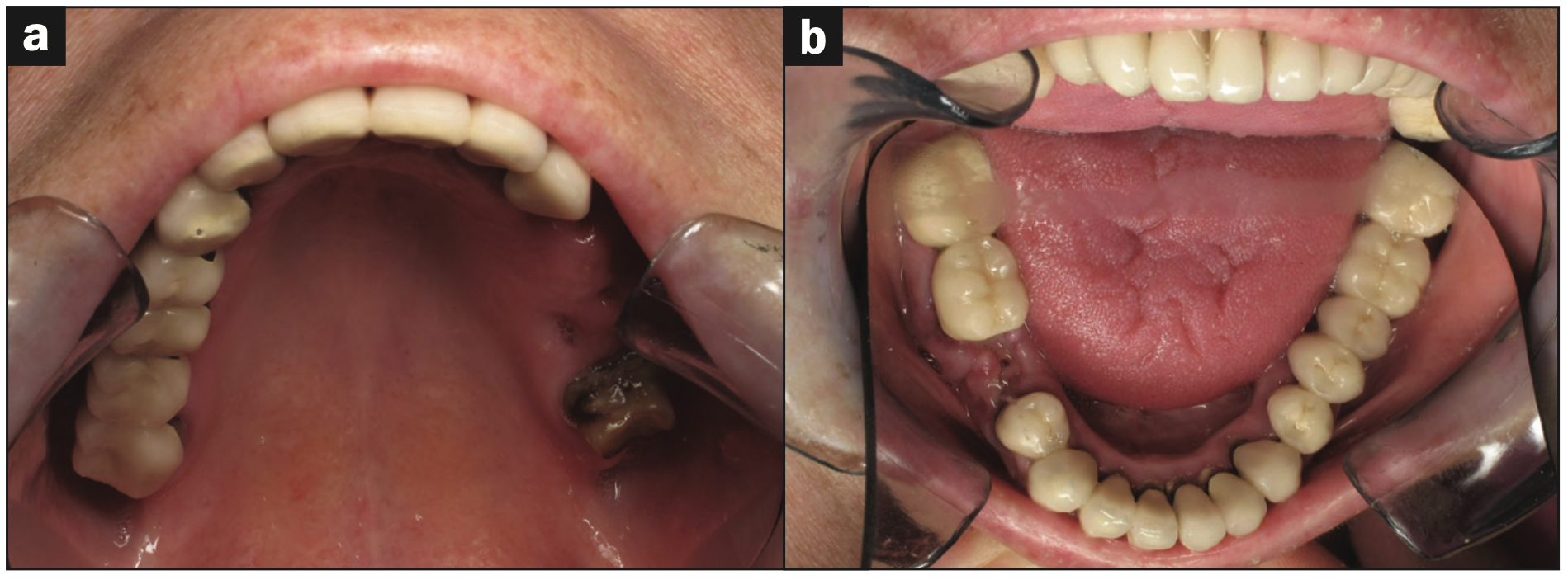 full-mouth rehabilitation