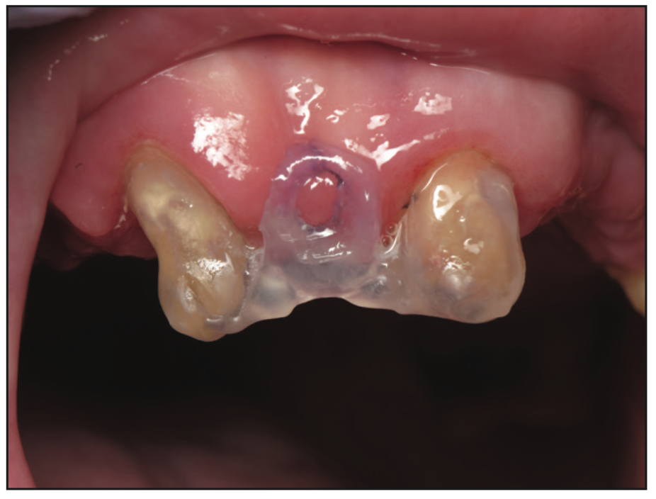 full-mouth rehabilitation