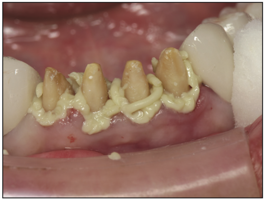 full-mouth rehabilitation