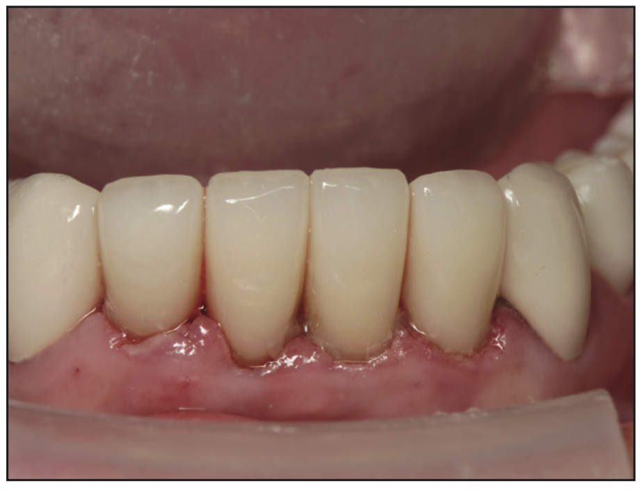 full-mouth rehabilitation