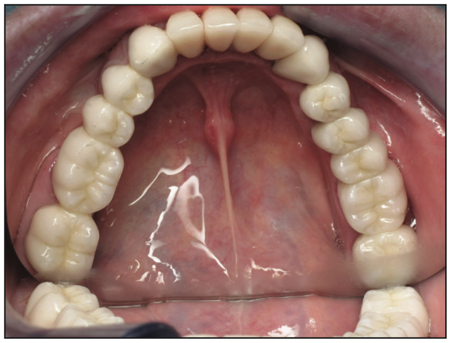 full-mouth rehabilitation