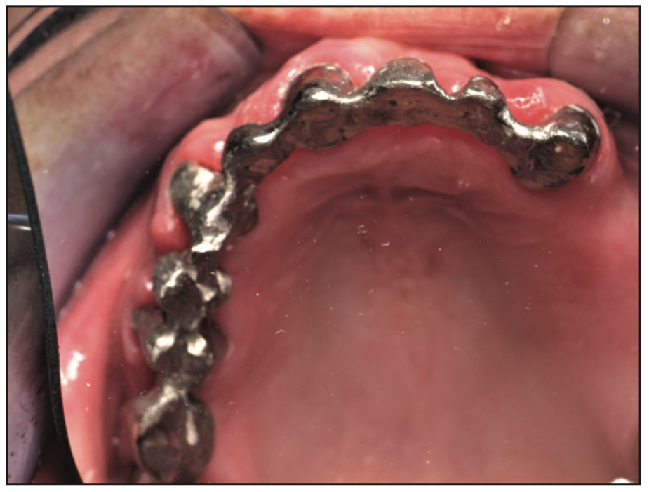 full-mouth rehabilitation