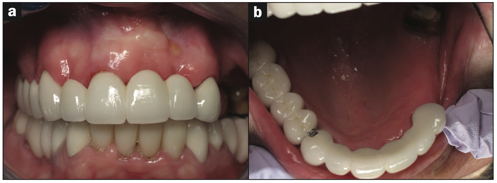full-mouth rehabilitation