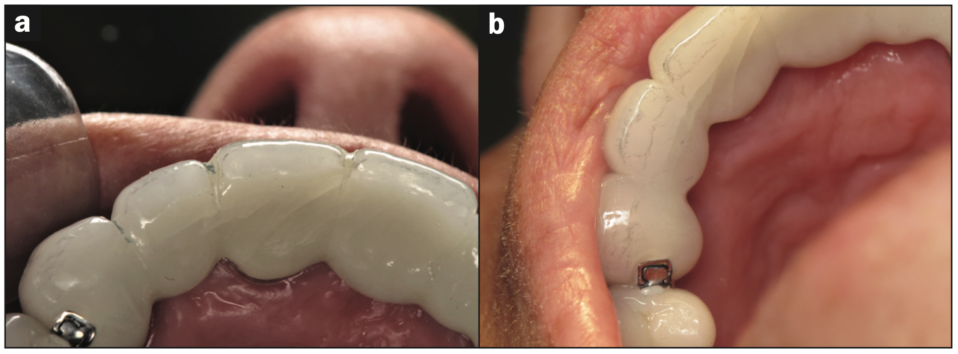 full-mouth rehabilitation