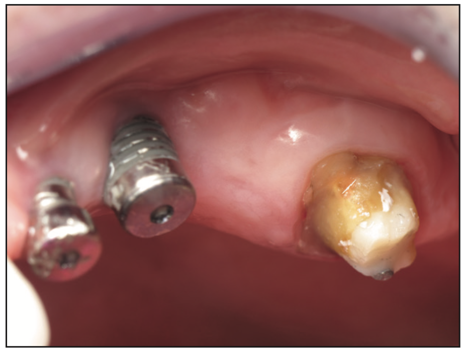 full-mouth rehabilitation