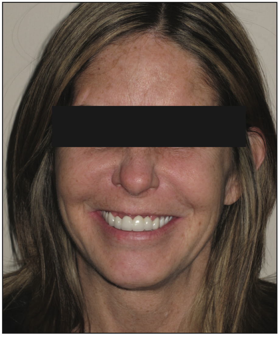 full-mouth rehabilitation
