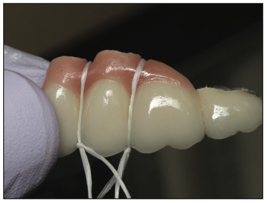full-mouth rehabilitation