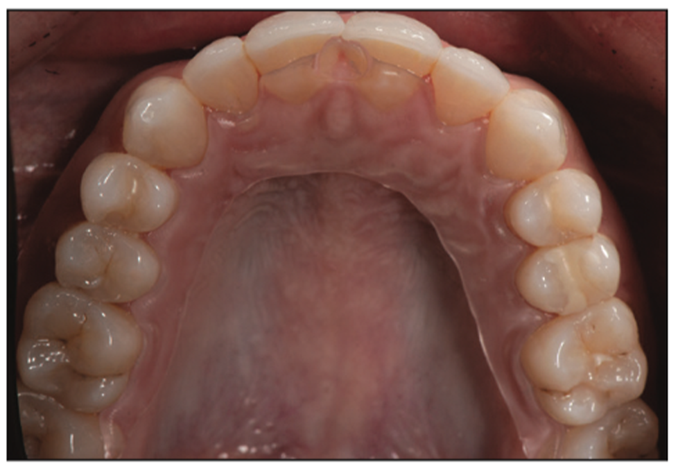 prepless smile enhancement