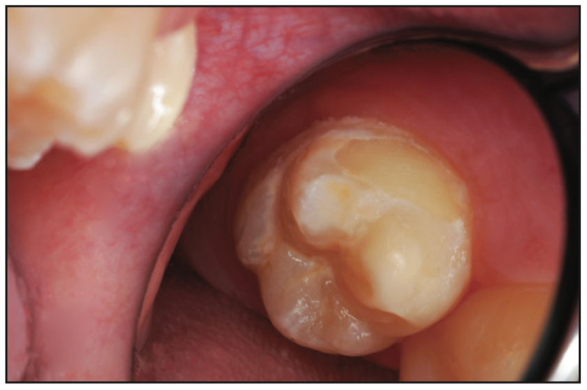 smooth-surface dental caries