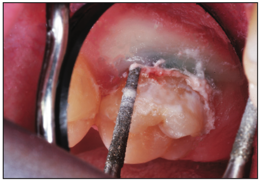 smooth-surface dental caries