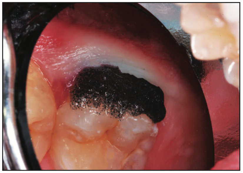 smooth-surface dental caries