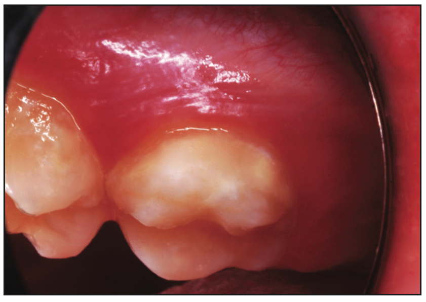 smooth-surface dental caries