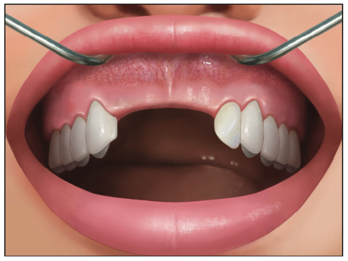 Ridge Expansion Osteotomy