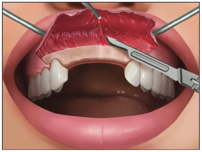 Ridge Expansion Osteotomy