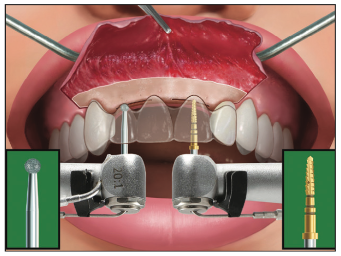 Ridge Expansion Osteotomy