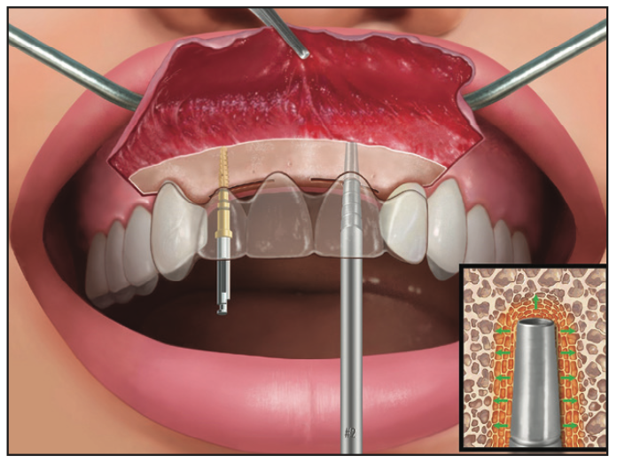 Ridge Expansion Osteotomy