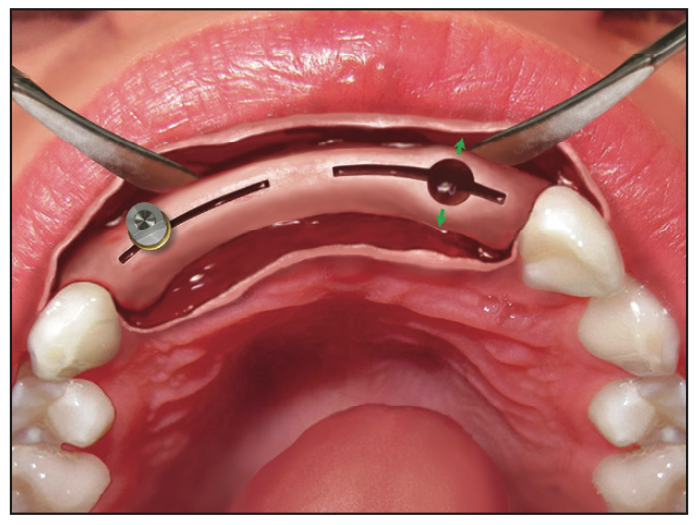 Ridge Expansion Osteotomy
