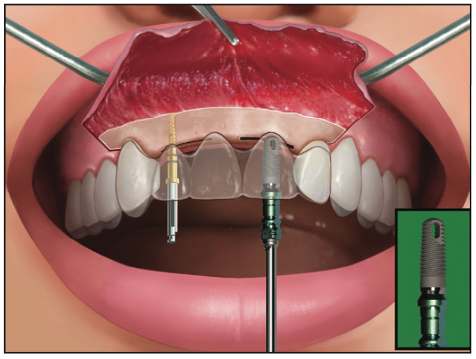 Ridge Expansion Osteotomy