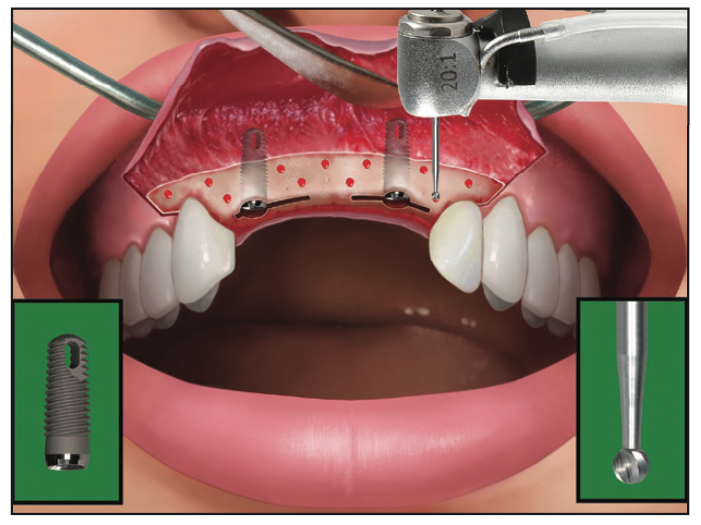 Ridge Expansion Osteotomy