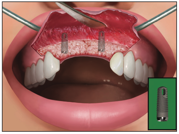 Ridge Expansion Osteotomy