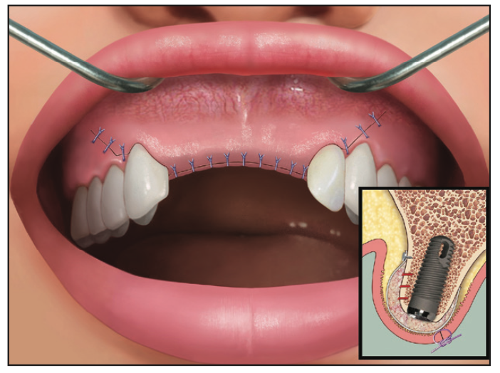 Ridge Expansion Osteotomy