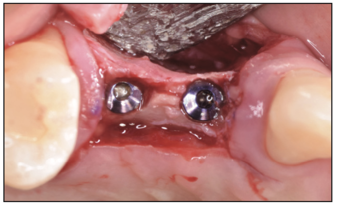 Ridge Expansion Osteotomy