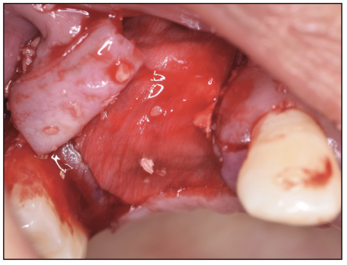 Ridge Expansion Osteotomy