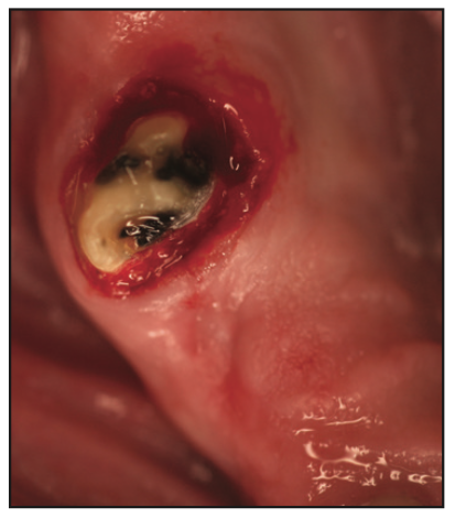 temporary gingival retraction