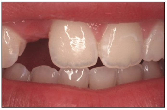 Minimally Invasive Bonded Bridges