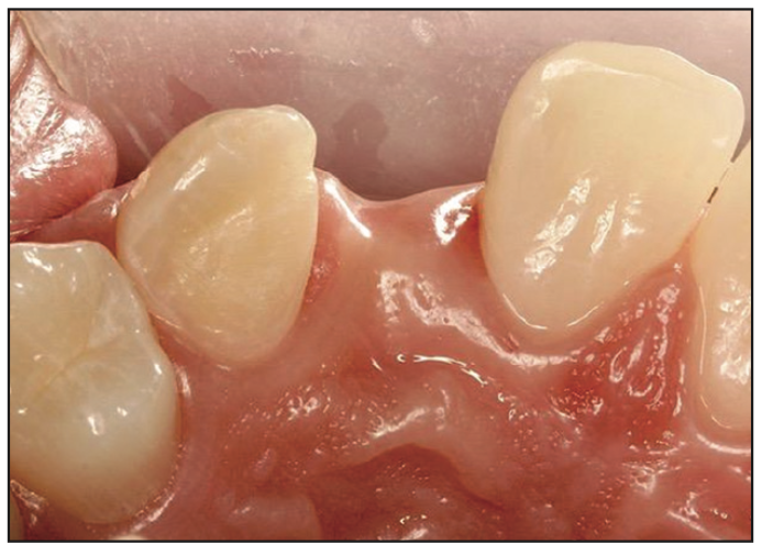 Minimally Invasive Bonded Bridges
