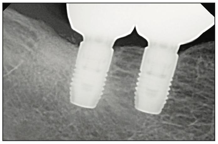 splint