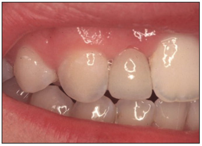 Minimally Invasive Bonded Bridges