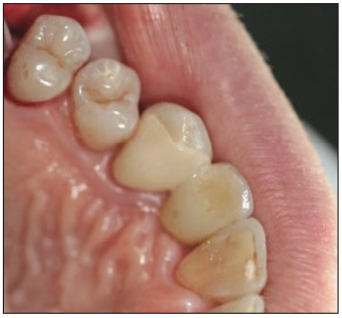 Minimally Invasive Bonded Bridges