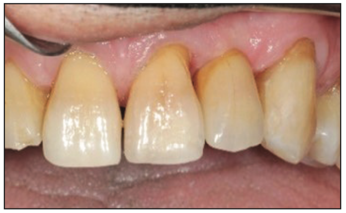 Minimally Invasive Bonded Bridges