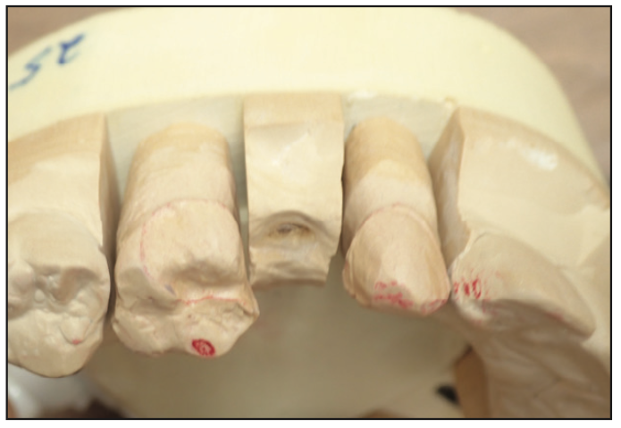 Minimally Invasive Bonded Bridges