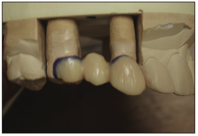 Minimally Invasive Bonded Bridges
