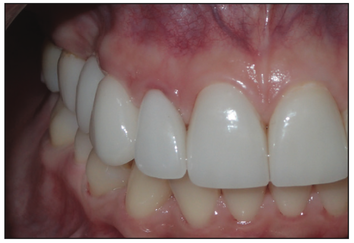 Minimally Invasive Bonded Bridges