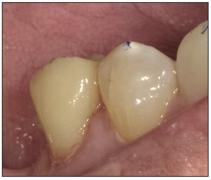 ceramic-based resin