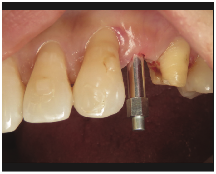ceramic implants