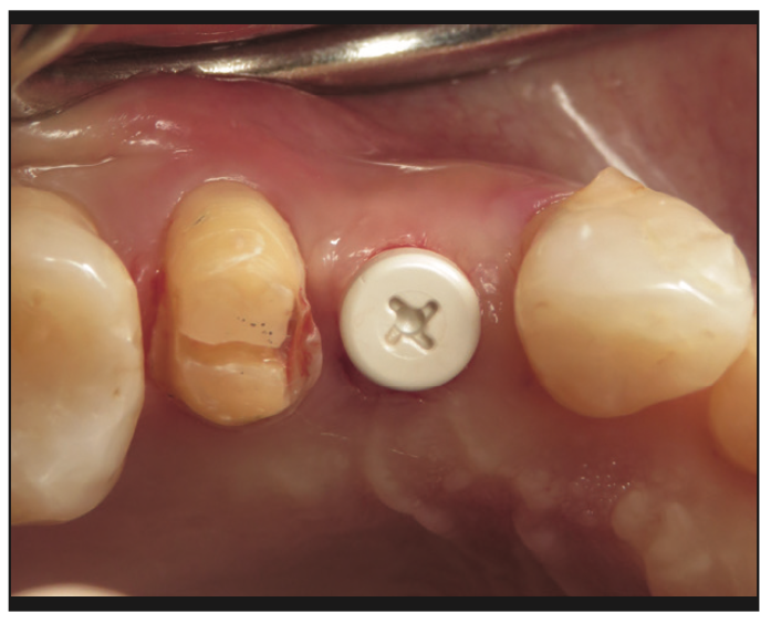 ceramic implants