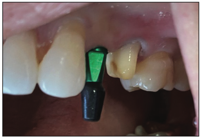 ceramic implants